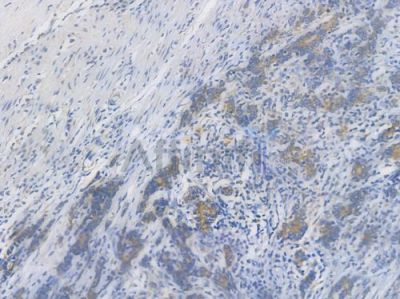 TOMM20 Recombinant Rabbit mAb - BF3180 at 1/100 staining Human gastric carcinoma by IHC-P.