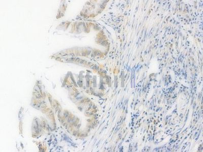 GRP78 Recombinant Rabbit mAb - BF3235 at 1/100 staining Human pancreatic carcinoma by IHC-P.