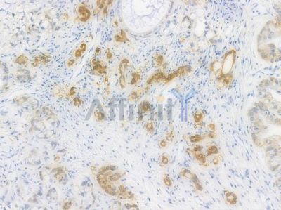 SCD1 Recombinant Rabbit mAb - BF3271 at 1/100 staining Human pancreatic carcinoma by IHC-P.