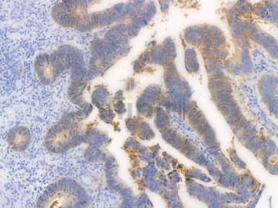 Claudin 3 Recombinant Rabbit mAb - BF3292 at 1/100 staining Human intestinal carcinoma by IHC-P.