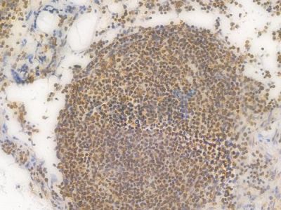 VDAC1 Recombinant Rabbit mAb - BF3302 at 1/100 staining Human lymph node carcinoma by IHC-P.