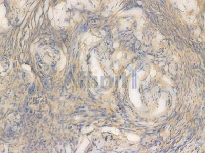 FIS1 Recombinant Rabbit mAb - BF3319 at 1/100 staining Human ovarian carcinoma by IHC-P.