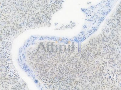 GATA3 Recombinant Rabbit mAb - BF3323 at 1/100 staining Human renal carcinoma by IHC-P.