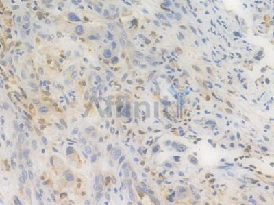 IRF5 Recombinant Rabbit mAb - BF3350 at 1/100 staining Human intestinal carcinoma by IHC-P.