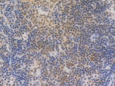 IRF5 Recombinant Rabbit mAb - BF3350 at 1/100 staining Human lymph node carcinoma by IHC-P.
