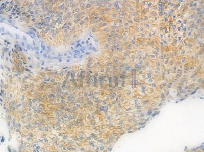ASK1 Recombinant Rabbit mAb - BF3379 at 1/100 staining Human renal carcinoma by IHC-P.