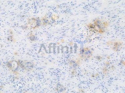 EpCAM Recombinant Rabbit mAb - BF3401 at 1/100 staining Human intestinal carcinoma by IHC-P.