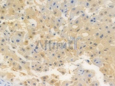 NAMPT Recombinant Rabbit mAb - BF3402 at 1/100 staining Human liver carcinoma by IHC-P.