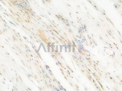 c-Met Recombinant Rabbit mAb - BF3413 at 1/100 staining Human esophageal carcinoma by IHC-P.