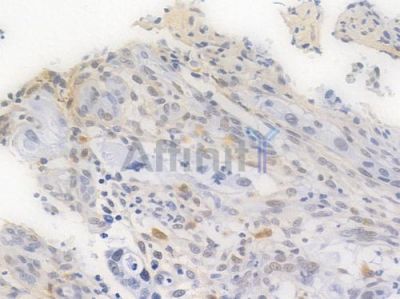 NRF1 Recombinant Rabbit mAb - BF3456 at 1/100 staining Human intestinal carcinoma by IHC-P.