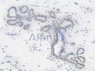NRF1 Recombinant Rabbit mAb - BF3456 at 1/100 staining Human breast carcinoma by IHC-P.