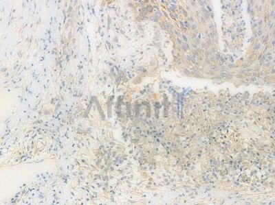 Integrin  alpha V Recombinant Rabbit mAb - BF3511 at 1/100 staining Human esophageal carcinoma by IHC-P.