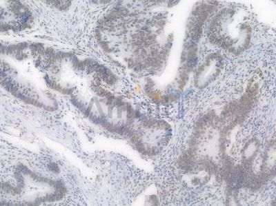 SP1 Recombinant Rabbit mAb - BF3512 at 1/100 staining Human intestinal carcinoma by IHC-P.