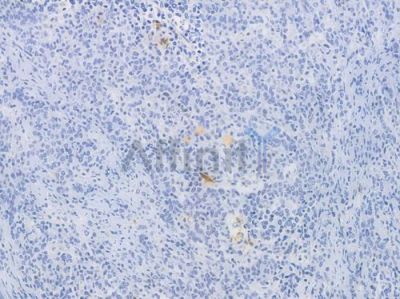 S100B Recombinant Rabbit mAb - BF3545 at 1/100 staining Human gastric carcinoma by IHC-P.
