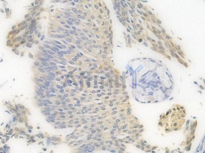 ENO1 Recombinant Rabbit mAb - BF3552 at 1/100 staining Human renal carcinoma by IHC-P.