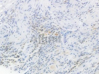 RPS6 Recombinant Rabbit mAb - BF3580 at 1/100 staining Human gastric carcinoma by IHC-P.