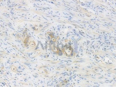 CD147 Recombinant Rabbit mAb - BF3593 at 1/100 staining Human intestinal carcinoma by IHC-P.
