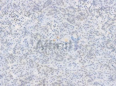 NR1D1 Recombinant Rabbit mAb - BF3706 at 1/100 staining Human gastric carcinoma by IHC-P.