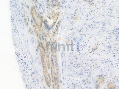 ALDH2 Recombinant Rabbit mAb - BF3714 at 1/100 staining Human intestinal carcinoma by IHC-P.