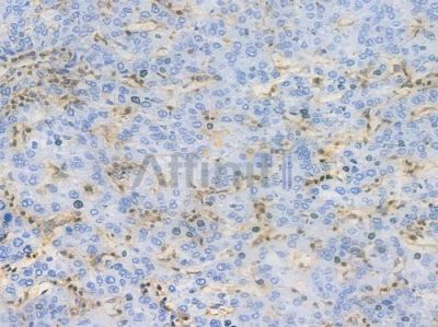 Annexin A1 Recombinant Rabbit mAb - BF3802 at 1/100 staining Human liver carcinoma by IHC-P.