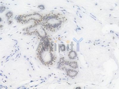 RUNX1 / AML1 Recombinant Rabbit mAb - BF3816 at 1/100 staining Human breast carcinoma by IHC-P.