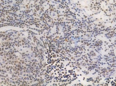 RUNX1 / AML1 Recombinant Rabbit mAb - BF3816 at 1/100 staining Human lymph node carcinoma by IHC-P.