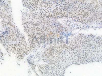 HDAC9 Recombinant Rabbit mAb - BF3833 at 1/100 staining Human renal carcinoma by IHC-P.