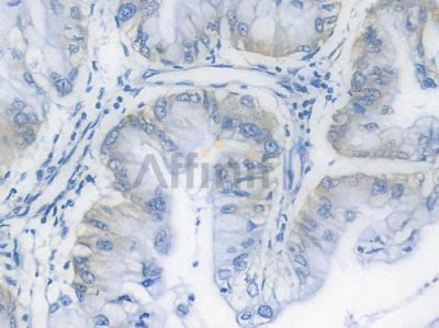 BTF3 Recombinant Rabbit mAb - BF3880 at 1/100 staining Human pancreatic carcinoma by IHC-P.