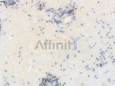 FGG Recombinant Rabbit mAb - BF3881 at 1/100 staining Human gastric tissue by IHC-P.