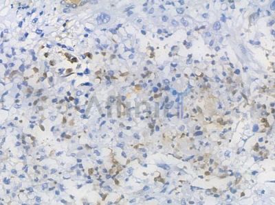 CDC6 Recombinant Rabbit mAb - BF3894 at 1/100 staining Human esophageal carcinoma by IHC-P.