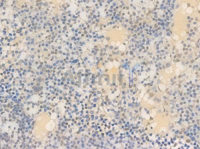 GAPDH Recombinant Rabbit mAb - BF3906 at 1/100 staining Human lymph node carcinoma by IHC-P.