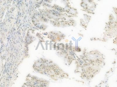 GAPDH Recombinant Rabbit mAb - BF3906 at 1/100 staining Human pancreatic carcinoma by IHC-P.
