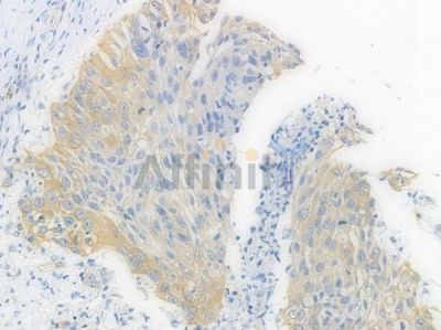 alpha Tubulin Recombinant Rabbit mAb - BF3914 at 1/100 staining Human esophageal carcinoma by IHC-P.