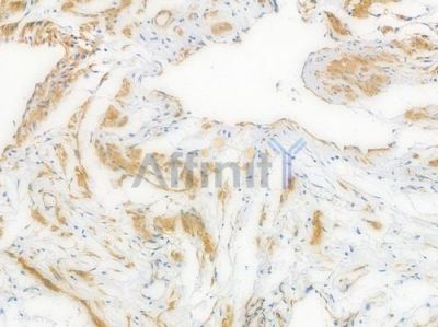 Vinculin Recombinant Rabbit mAb - BF3916 at 1/100 staining Human ovarian carcinoma by IHC-P.