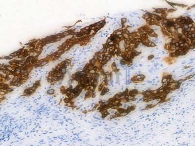 Cytokeratin 6 Recombinant Rabbit mAb - BF3929 at 1/100 staining Human esophageal carcinoma by IHC-P.