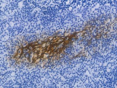 Cytokeratin 6 Recombinant Rabbit mAb - BF3929 at 1/100 staining Human tonsil tissue by IHC-P.