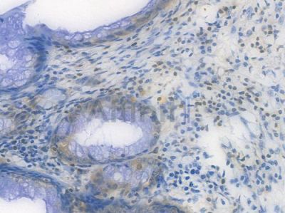 RSK3 Recombinant Rabbit mAb - BF3930 at 1/100 staining Human appendiceal carcinoma by IHC-P.