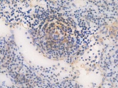 Flotillin 1 Recombinant Rabbit mAb - BF3937 at 1/100 staining Human lymph node carcinoma by IHC-P.
