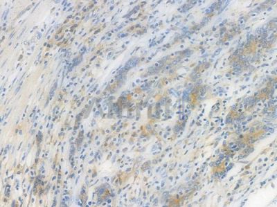 Flotillin 1 Recombinant Rabbit mAb - BF3937 at 1/100 staining Human gastric carcinoma by IHC-P.