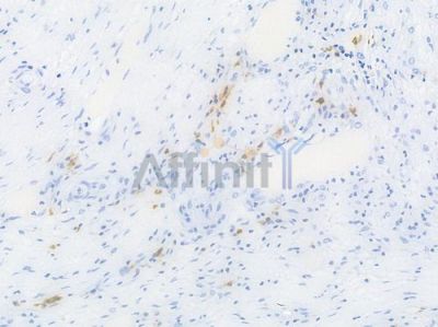 CD79A Recombinant Rabbit mAb - BF3940 at 1/100 staining Human esophageal carcinoma by IHC-P.