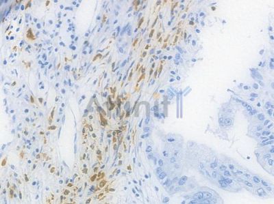 CD79A Recombinant Rabbit mAb - BF3940 at 1/100 staining Human pancreatic carcinoma by IHC-P.