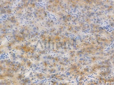MDR1 Recombinant Rabbit mAb - BF3944 at 1/100 staining Human liver carcinoma by IHC-P.