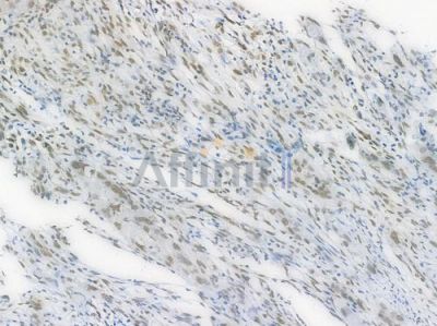 Phospho-STAT1 (Ser727) Recombinant Rabbit mAb - BF3955 at 1/100 staining Human intestinal carcinoma by IHC-P.