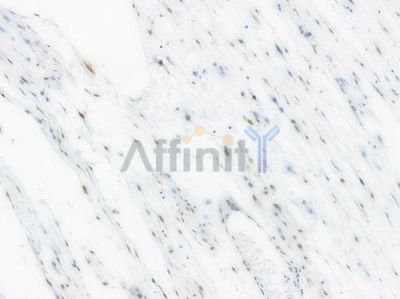 Phospho-STAT1 (Ser727) Recombinant Rabbit mAb - BF3955 at 1/100 staining Human esophageal carcinoma by IHC-P.