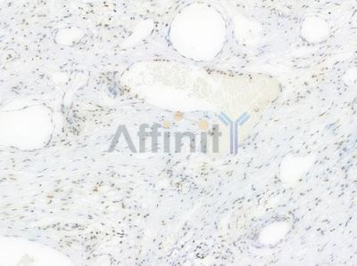 Acetyl-Histone H3 (Lys27) Recombinant Rabbit mAb - BF3958 at 1/100 staining Human esophageal carcinoma by IHC-P.
