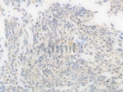 Caspase 3 Recombinant Rabbit mAb - BF3964 at 1/100 staining Human renal carcinoma by IHC-P.