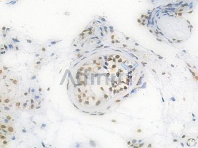 Lamin A/C Recombinant Rabbit mAb - BF3968 at 1/100 staining Human testicular carcinoma by IHC-P.