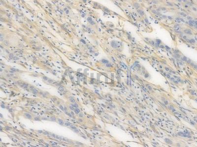 Caveolin 1 Recombinant Rabbit mAb - BF3969 at 1/100 staining Human intestinal carcinoma by IHC-P.