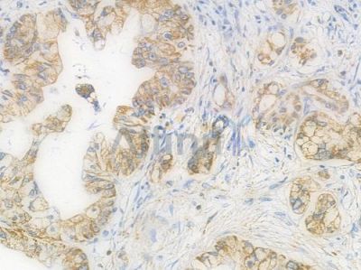 TSPO Recombinant Rabbit mAb - BF3970 at 1/100 staining Human pancreatic carcinoma by IHC-P.