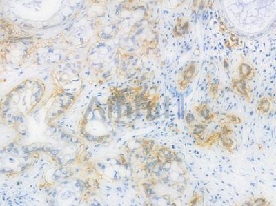 TACD2 Recombinant Rabbit mAb - BF3976 at 1/100 staining Human pancreatic carcinoma by IHC-P.